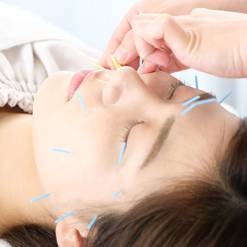 美容鍼